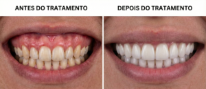 paciente da clinica odontologica vidaplena em jundiai antes e depois de um sorriso que era gengival.