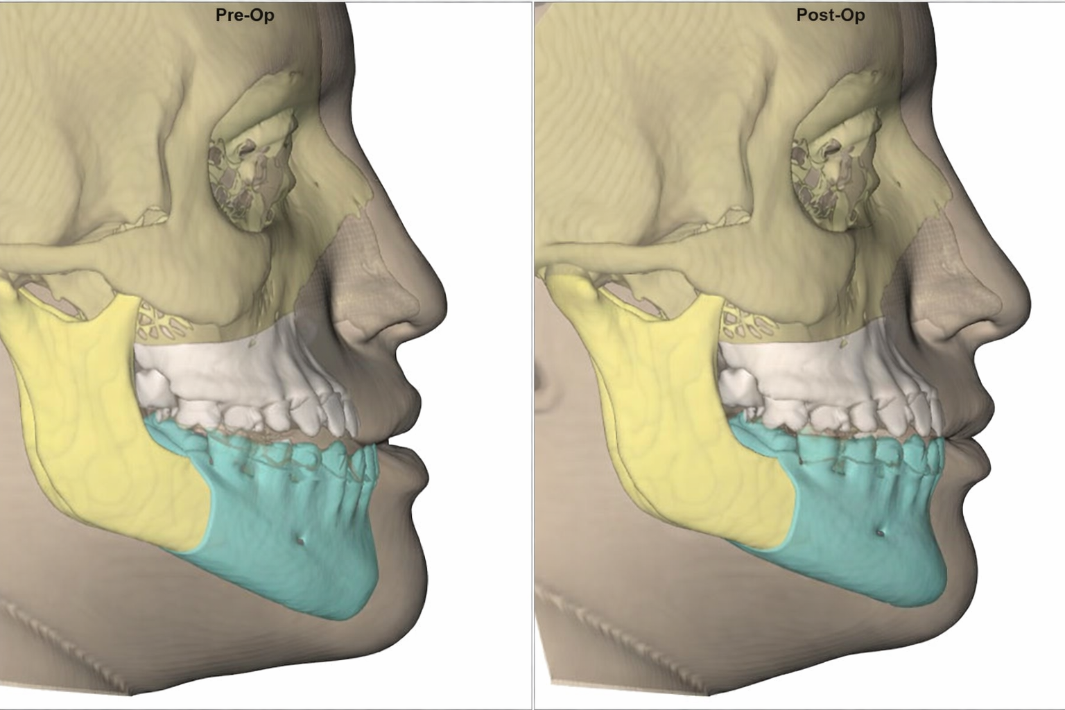 Ilustração de Cirurgia Ortognática - Vida Plena