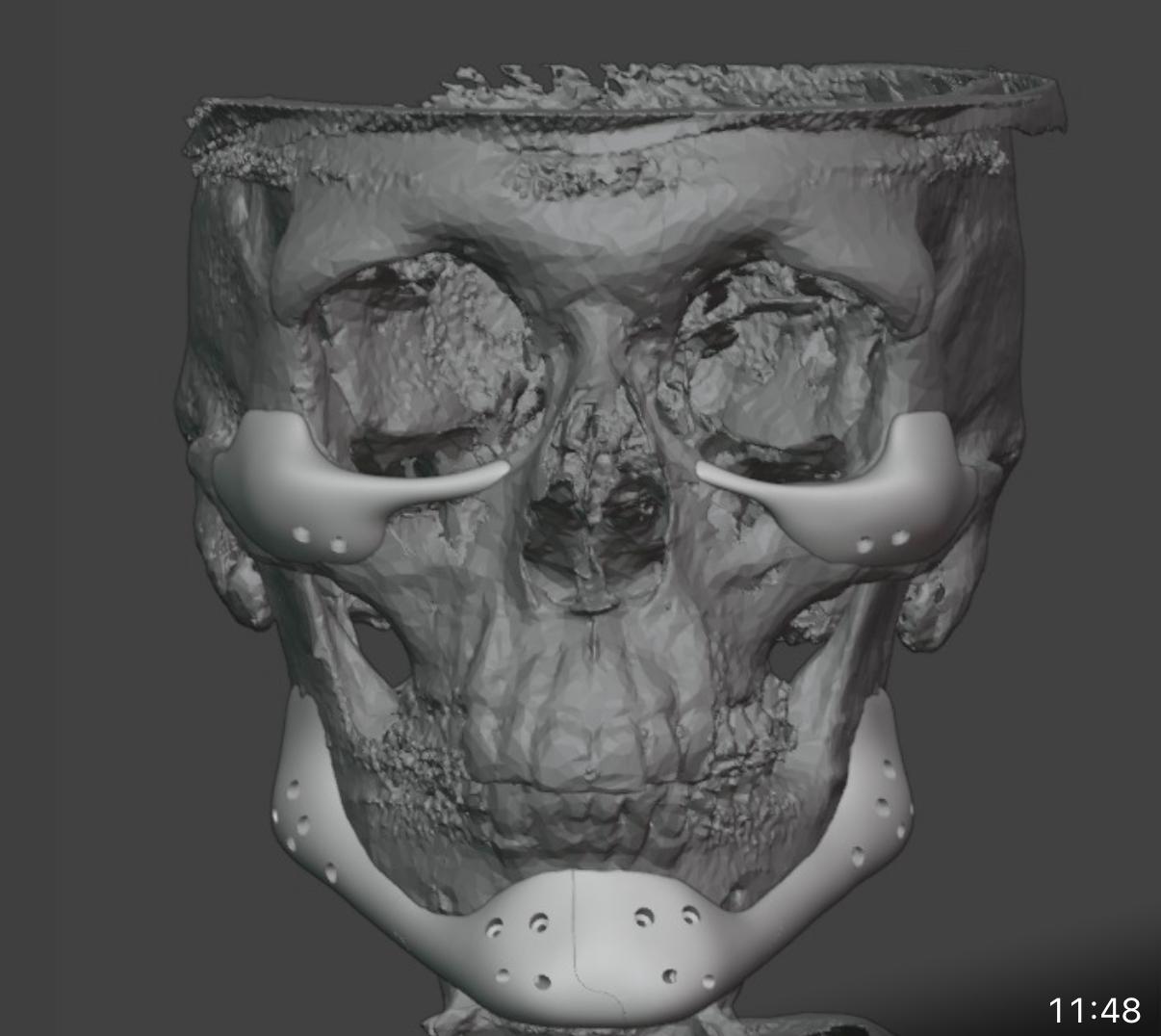 Prótese Facial 1 VidaPlena