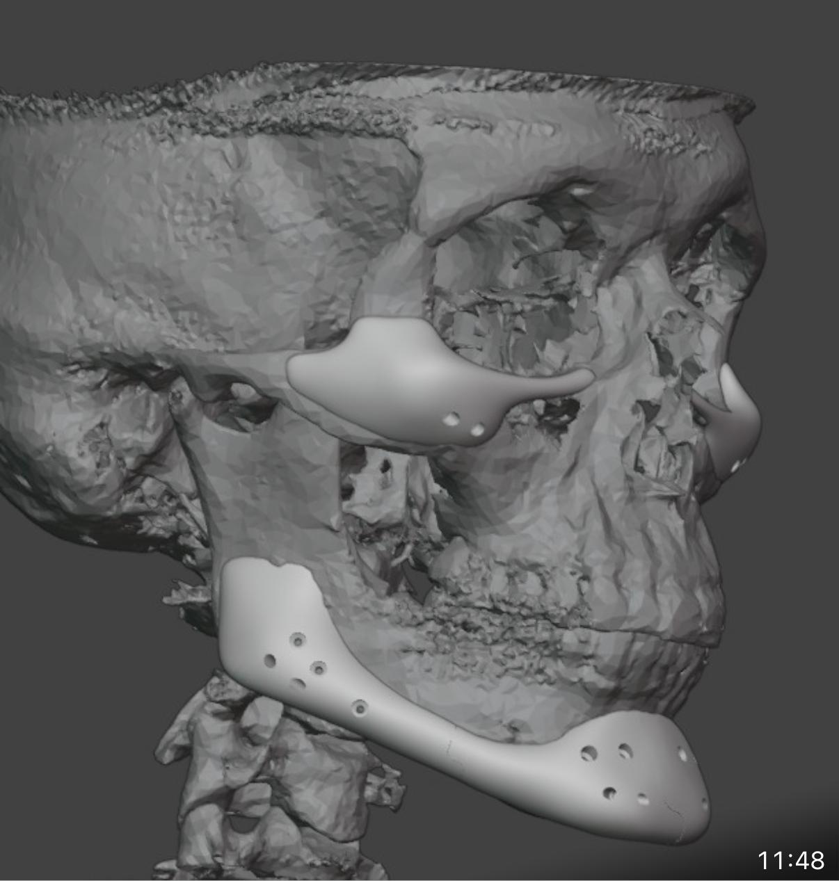 Prótese Facial 2 VidaPlena